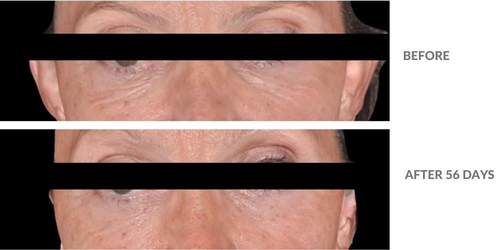cebelia t10 eye lift 3
